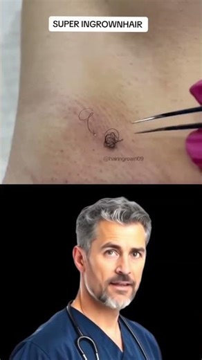 [The Most Satisfying Ingrown Hair Pull You’ll See Today] – Derma Extracts | Satisfying Dermatology