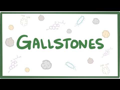 Gallstones (cholelithiasis)