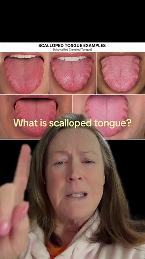 As a person living with Sjogren’s disease, this is something I wish more people knew about. See those indentations along the sides of the tongue? That’s called a scalloped tongue. A scalloped tongue can happen when the tongue presses against the teeth, but it can also be associated with dry mouth, sleep apnea, inflammation, and autoimmune medical conditions like Sjogren’s disease. When your salivary glands aren’t producing enough saliva, the tissues in your mouth can change over time. It’s not a