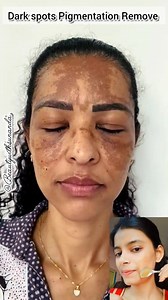 1.4M views · 5.1K reactions | Face Pack For Tan Free Skin | Remove Dark spot pigmentation Naturally  #shorts #darkspots #pigmantation #fypシviralシ2024 #fypシ゚viralシfypシ゚viralシalシ #fbreelsfypシ゚viral #reelsfbviral #reelsfbシ #fbreels #fbreelsvideo #trendingreels #reelsfb #fypシ #fbreelsfypシ゚ #fbreelsfypシ゚viralシ | Beauty With Sunanda | Facebook