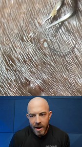 Super satisfying ingrown hair removal compilation! #ingrownhairremoval #dermreacts #doctorreacts | Dr. Dustin Portela, Dermatologist