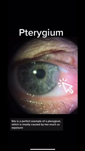 Pterygium, caused by sun damage and can be prevented by good quality sunglasses!