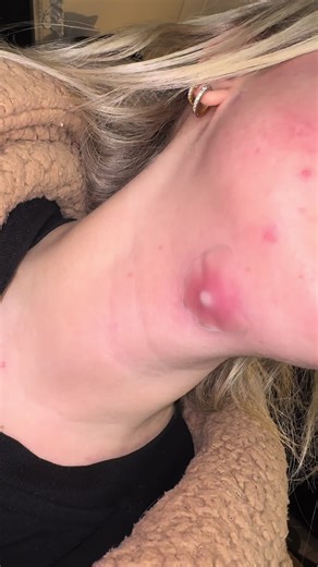 Overcoming Cystic Acne Pain with Litbear