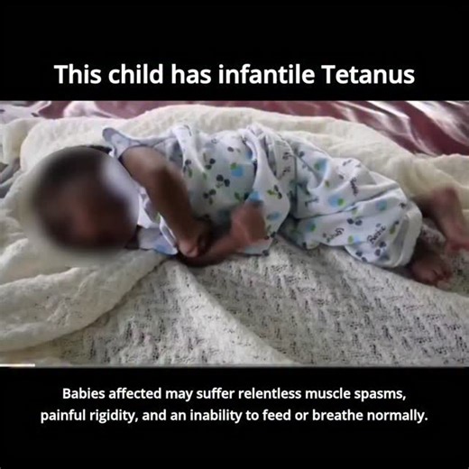 Medicinefile on Instagram: "This is what life looked like before vaccines. This child has infantile Tetanus, a vaccine preventable bacterial infection. Babies affected may suffer relentless muscle spasms, painful rigidity, and an inability to feed or breathe normally. Even with treatment, many do not survive; those who do may be left with lasting neurological damage. #tetanus #vaccine"
