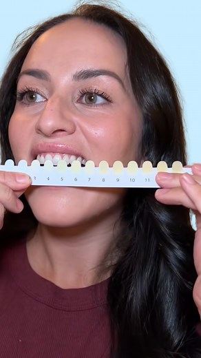 the results speak for themselves ✨ Clinically proven to whiten your teeth 8 shades in 7 days (on average), Supersmile’s fast-dissolving teeth whitening strips are light years ahead of usual whitening strips. Convenient, easy, and safe teeth whitening strips designed for people who want results fast and without the messiness of traditional (non-dissolving) strips. Ideal for those looking for teeth whitening without sensitivity and an easy alternative to longer-wear teeth whitening strips! . . . #