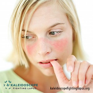 The Lupus Butterfly Rash: Information You Need to Know - Kaleidoscope Fighting Lupus