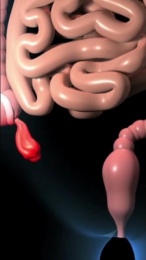 Appendicitis-3D animation #medical