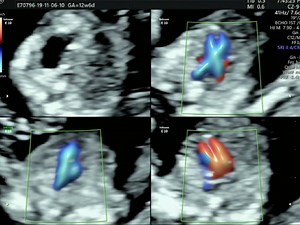 35 reactions | Why is #firsttrimester screening (FTS) for my baby?...