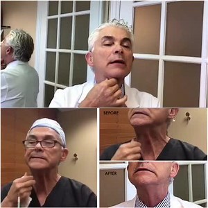 Correcting Neck Cords with Botox