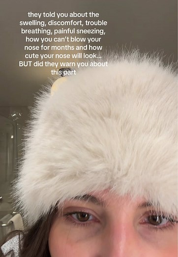 Understanding Rhinoplasty: The Not-So-Pretty Truth