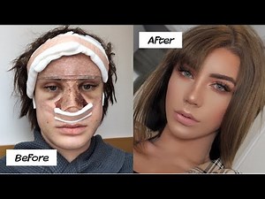 My plastic surgery in Korea experience! (part 2)