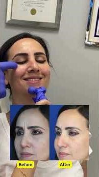 Botox for forehead lines, concept of natural results #botox