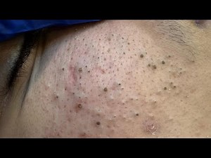 Deep Cleansing Techniques For Acne — Severe Pimple Removal