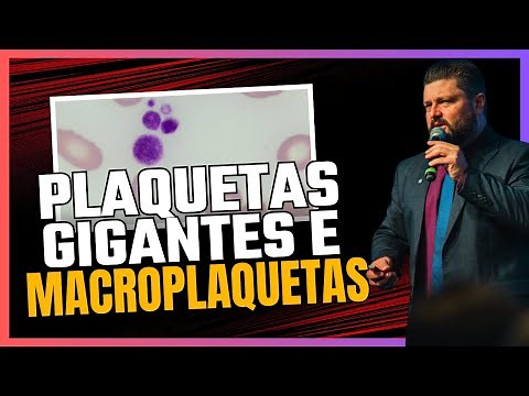 Macroplaquetas e Plaquetas Gigantes - Como Reconhecer e Liberar - Hematologia