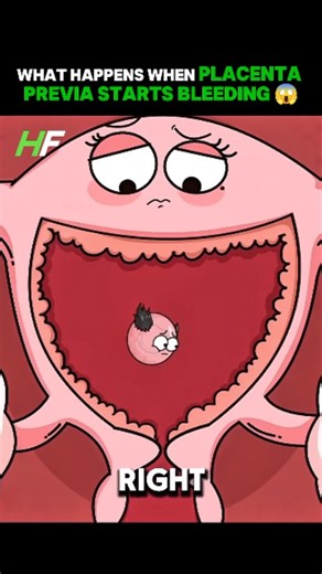 health | pregnancy | body on Instagram: "😱 Bleeding in late pregnancy? This is what placenta previa really looks like. 💥 The placenta sits too low. 💥 The cervix gets blocked. 💥 Bleeding can happen — even when the baby is strong. 🧠 Doctors confirm: With monitoring + a planned C-section, many babies are born healthy. ⚠️ Most people don’t know this… Bleeding doesn’t always mean something is wrong with the baby. - 🎥 This 3D animation shows the inside story your ultrasound can’t explain. - 👉 S