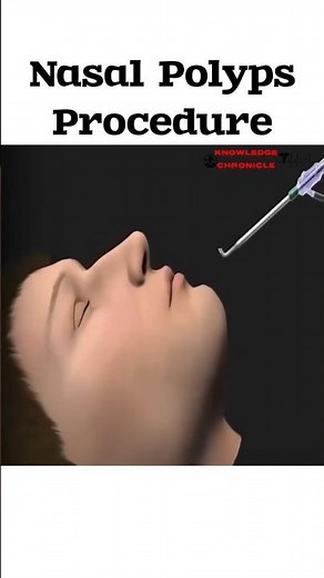 Nasal Polyps Removal Procedure: How Doctors Clear Blocked Sinuses Safely #shorts #trending #ytshorts
