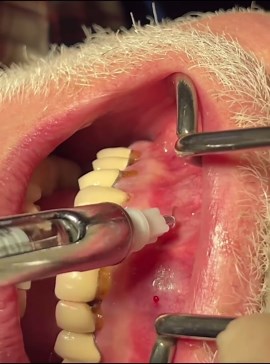 Dentistrysociety on Instagram: "One of my favorite anesthetic techniques. Anesthetizing the entire maxilla arch with a series of a few regional infiltrations. Something I learned when doing MMF for fracture reductions in residency. Start from one area, inject and deposit as you pull back. Next enter from anesthetized spot and repeat. Just make sure you’re high enough to reach over exostosis and not get blocked.  Case by @surgical_gourmet"