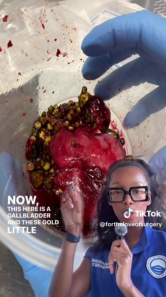 VERY abnormal gallbladder! Lap choles are one of the more “simple” procedures, but there is always risk for complications. As a Surgical Tech, I’ve seen it get reallllll sticky!