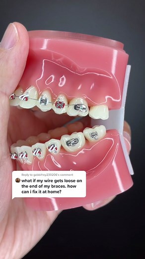 Braces Emergency: Wire came loose at the end