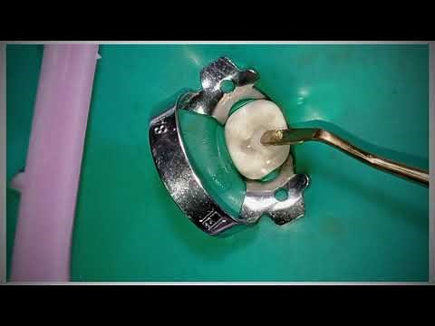 Restauración con resina en dientes temporales