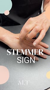 🔎 Dr. Karen Herbst is here to explain the Stemmer Sign (Kaposi-Stemmer Sign)—a simple pinch test used to check for lymphedema and fluid in the tissue. ✅ How it works: We check the hands, feet, fingers, or toes. If you can pinch the skin easily, there’s no fluid present. But if there’s a mound or it’s difficult to pinch, that indicates edema (fluid), meaning the Stemmer Sign is positive. 🚨 In Lipedema, the Stemmer Sign is typically negative—there’s no fluid buildup in the hands or feet, which h