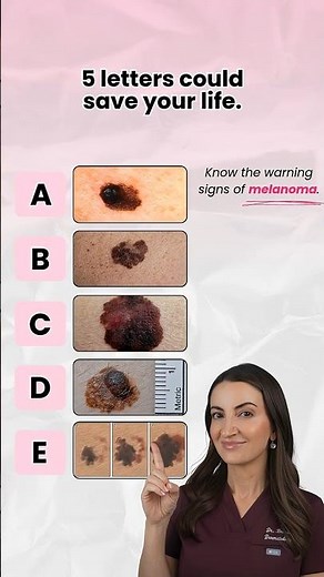 Melanoma Warning Signs: Know Your ABCDEs