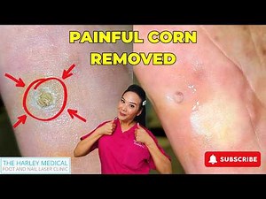 From Pain to Relief: Professional Corn Removal by Miss Foot Fixer Marion Yau