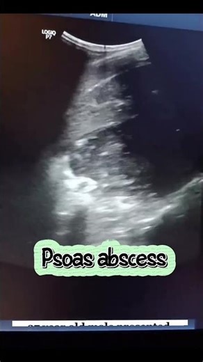 Psoas abscess..#beyondtheprobe #radiology #Cases #ultrasound