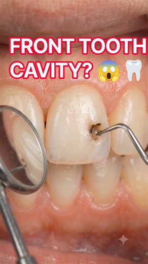 Cavity in Front Teeth 🦷 | Front Tooth Decay Treatment, Filling & Repair