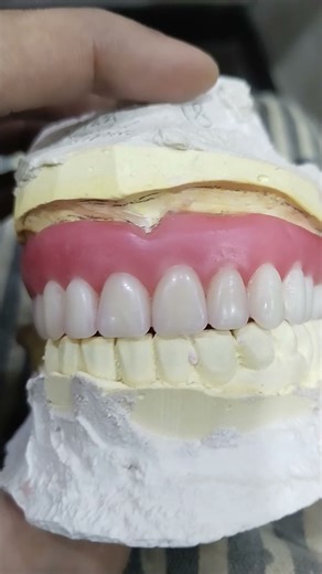 Soft Lining Complete Denture Ready for Flasking 😁😁😁#softdenture