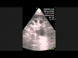 Hydronephrosis Grade III • Video • MEDtube.net