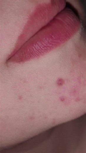 Skincare Tips for Acne-Prone Skin on the Chin