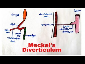 Meckels Diverticulum
