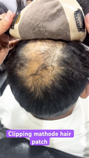 Clipping method, hair patch| #hairwig #wigs #hairpatch #hairlosscure #wigmaker #hairmaster #buxar