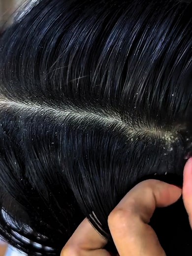 Dandruff hair scalp #DandruffScratching #ItchyDryScalp #HugeFlakes #Dandruff #dandrufftreatment #satisfying #dandruffremoval Disclaimer: Videos do not show original Dandruff, they are used for education purpose. Thank You,,,, | The Filmy