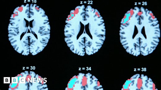 ECT patient information leaflets under review in Northern Ireland