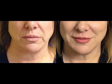 How to Get Rid of Vertical Lip Lines! Bye Bye Smoker Lines!