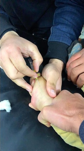 Best IV cannulation method.💉🥼 #hospital #emergencyroom #healthcare #usnurse #hospitaldepartment