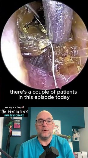 Juiciest EARWAX of 2026! full video in link below