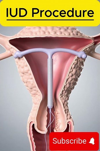 💊🩺 IUD Procedure – Intrauterine Device Insertion Explained #anotomy #humanbodysystem #science