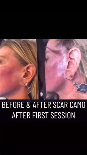 Scar Camouflage Tattoo Results After First Session #tattoo #scarcovering