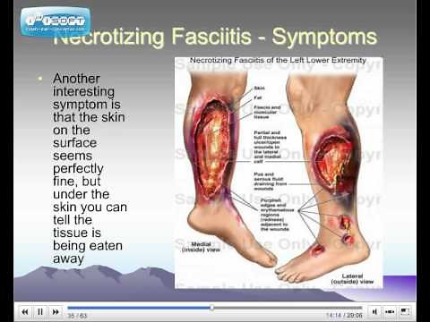 Necrotizing Fasciitis