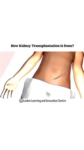 World of Biology on Instagram: "Kidney transplantation is a surgical procedure where a healthy kidney from a donor is placed into a person whose kidneys are no longer working. The process involves several steps: Preparation: The recipient undergoes evaluations, and the donor's kidney is matched for compatibility. Surgery: Under general anesthesia, a surgeon makes an incision in the lower abdomen and places the donor kidney in the recipient. The kidney is connected to the blood vessels and ureter