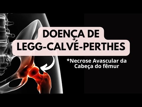 You need to watch this video: Avascular necrosis of the femoral head Legg-Calvé-Perthes disease