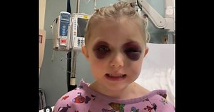 3-Year-Old Miraculously Survives Horse Kick to Face, Left with Facial Fractures and Brain Injury