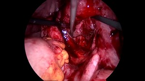 Video 8.1 Tubal Block and Hydrosalpinx