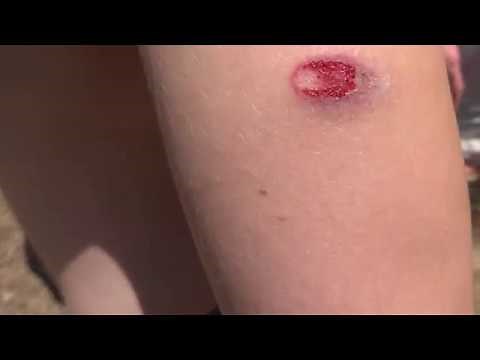 Shot with Rubber Buckshot