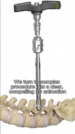 Percutaneous Pedicle Medical Animation - Pulse 3D Media
