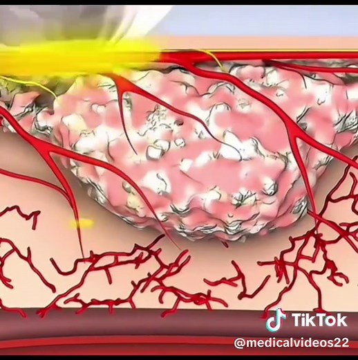 Modern ZSR Circumcision Technique Explained