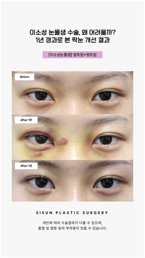 이소성 눈물샘 수술, 왜 어려울까? 1년 경과로 본 짝눈 개선 결과 #시선성형외과 #shrots